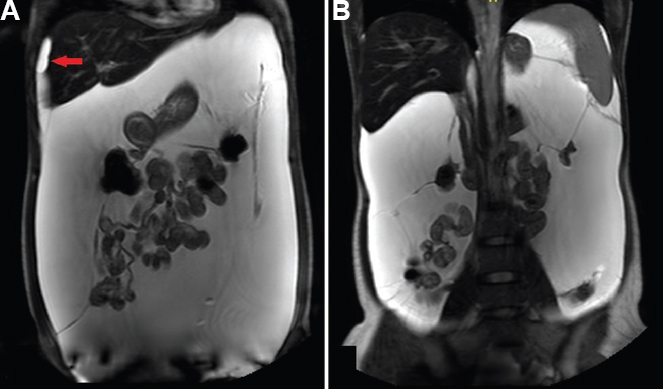 (A and B) T2-weighted coronal magnetic resonance imaging showing multi-loculated thin-walled cystic lesions filling the peritoneal cavity and scalloping the liver surface (arrow in A).